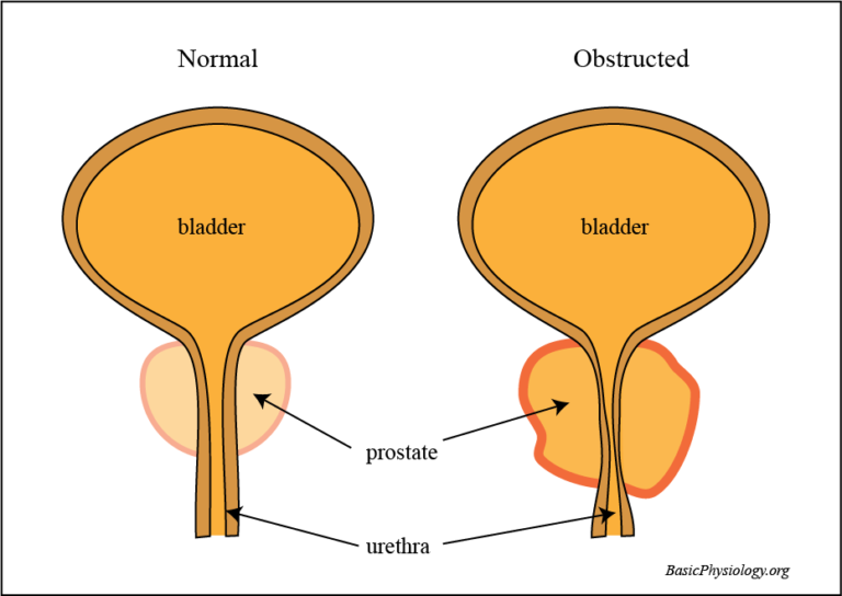 Diagram to show the effects of prostate hypertrophy on urethra obstruction in males