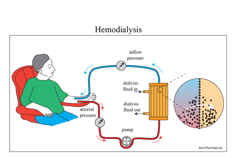 Diagram to show the function of hemodialysis with an artificial kidney in a patient