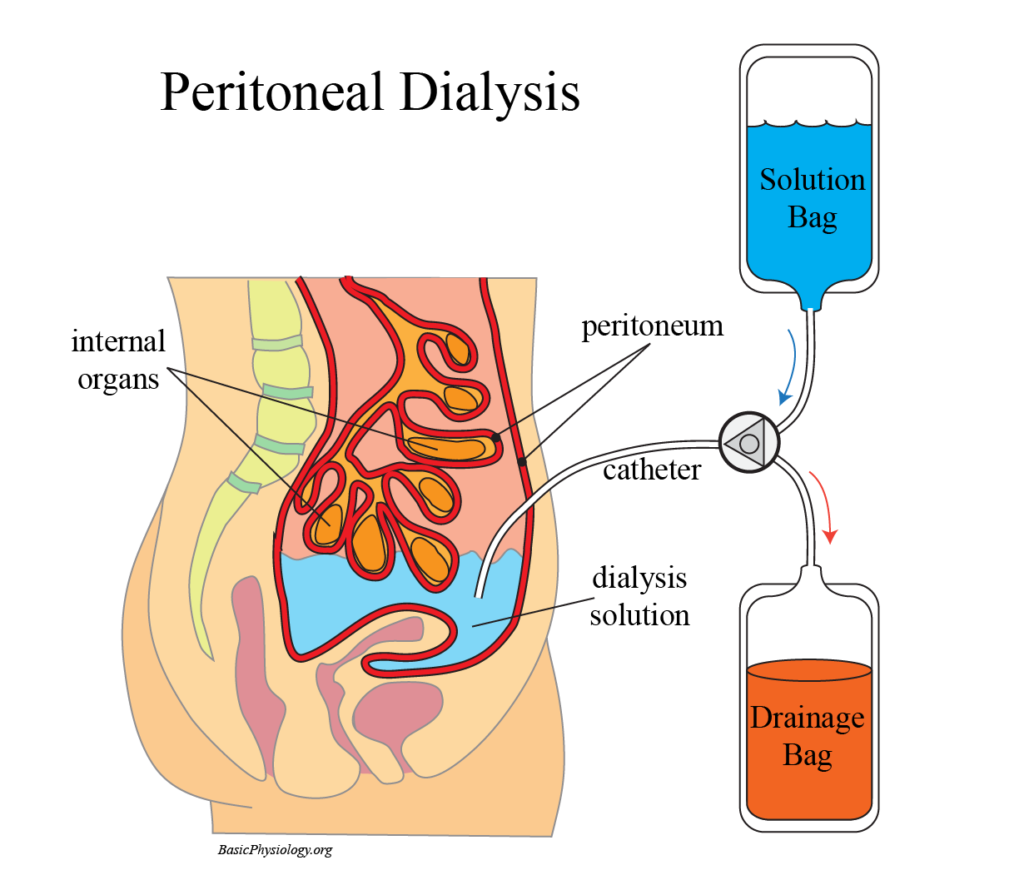 Diagram to show the function of peritoneal dialysis as an alternative to an artificial kidney